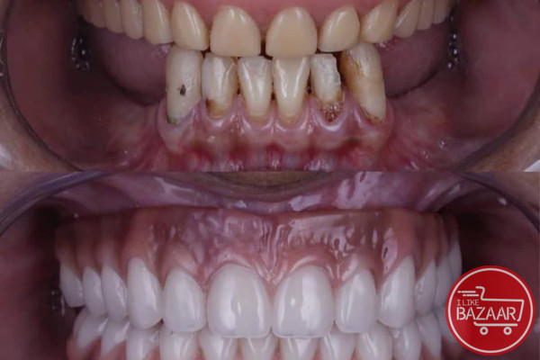 لابراتوار دندانسازی مروارید ساخت انواع دندان مصنوعی