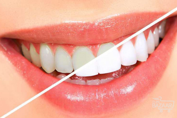 خدمات دندان پزشکی با ۳۵% تخفیف ویژه